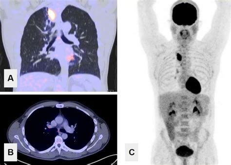 What is a High SUV on PET Scan: A Multifaceted Discussion on Its Implications and Interpretations